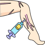 Varicose Veins